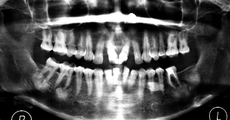 Orthopantomogram Showing Multiple Well Defined Sclerotic Masses With