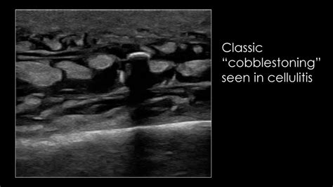 Ultrasound Of The Week Cellulitis Vs Abscess Ppt Download