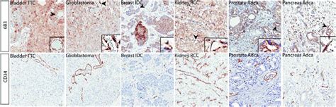 Pdgf Cc Expression Is Increased In Various Human Tumour Tissues In