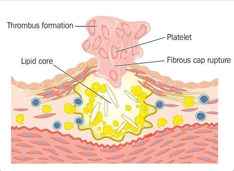 Rupture Of The Cap Covering An Atherosclerotic Lesion Resulting In