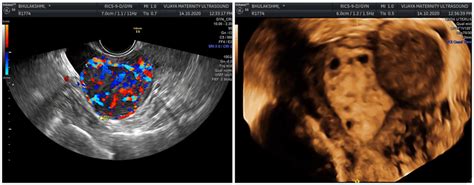 Ultrasound image showing a Fibroid with increased vascularity and 3D ...