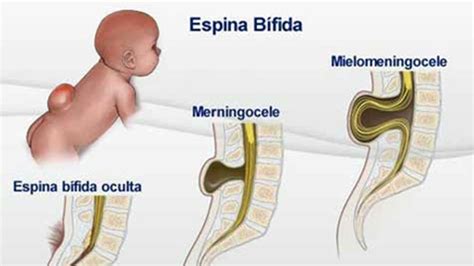 Cómo Es La Cirugía Fetal única En El País Contra La Espina Bífida