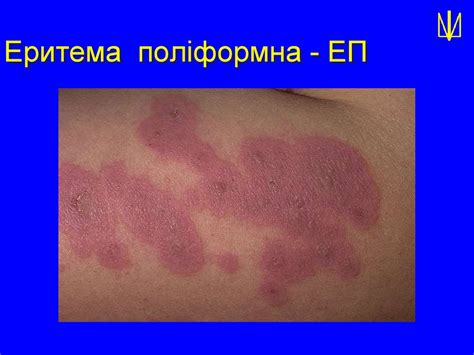 Еритематозні ураження шкіри - презентация онлайн