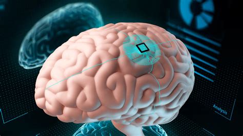 Arrancan Pruebas Humanas De Implante De Chip Para El Cerebro