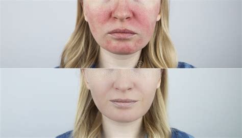 Rosacea Face The Girl Suffers From Redness On Her Cheeks Couperosis Of The Skin Redness And