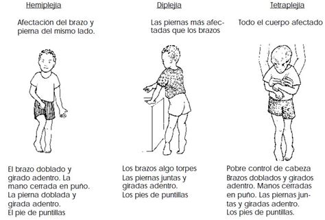 Parálisis Cerebral Fisioterapia Neurológica