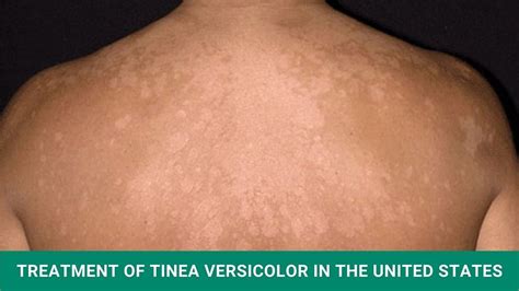 Treatment Of Tinea Versicolor In The United States