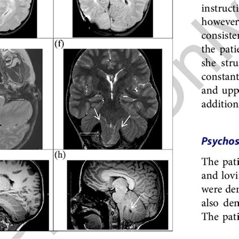 (PDF) Megalencephaly-capillary malformation polymicrogyria: A review ...