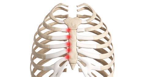 Broken Sternum X Ray