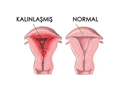 Rahim kalınlaşması neden olur Kadın Hastalıkları ve Gebelik ForumSever