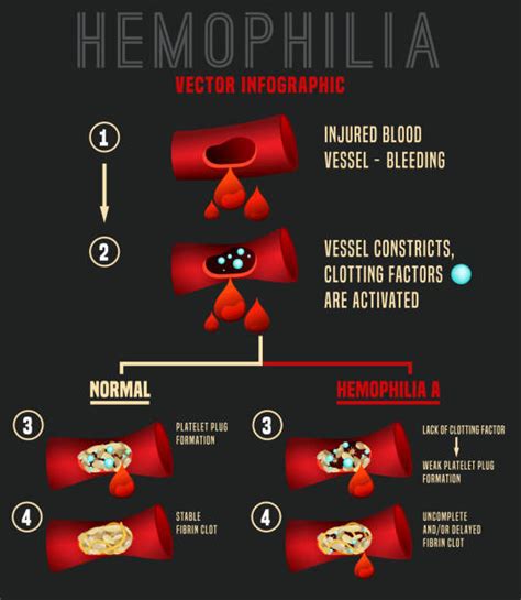 Hemophiliac Illustrations Royalty Free Vector Graphics And Clip Art Istock