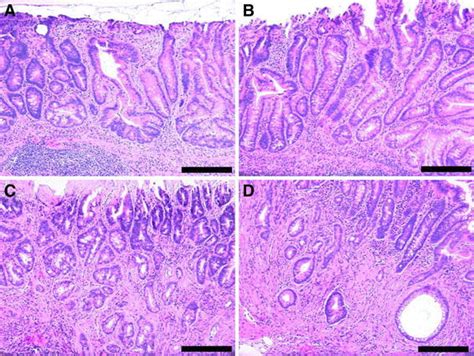 Two Areas Of Mouse Colonic Mucosa With Sessile Serrated Adenomas A B