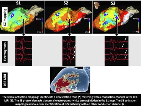 Po 03 242 The Benefit Of A Double Ventricular Extra Stimuli Protocol To Improve Functional