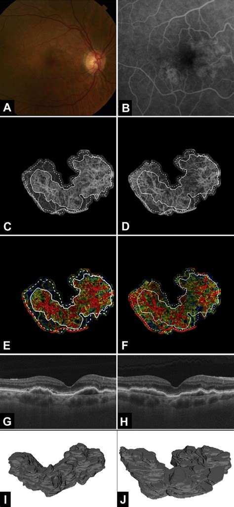 Multimodal Longitudinal Imaging Of Chronic Choroidal Neovascularization