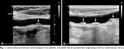 Figure 1 From Evaluation Of Carotid Plaque Using Ultrasound Imaging Semantic Scholar