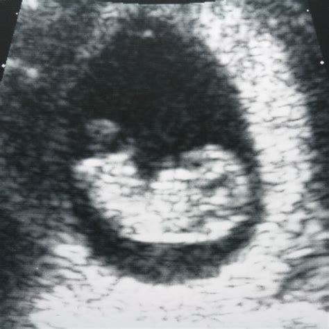 10. SSW: Entwicklung, Symptome und Ultraschallbilder