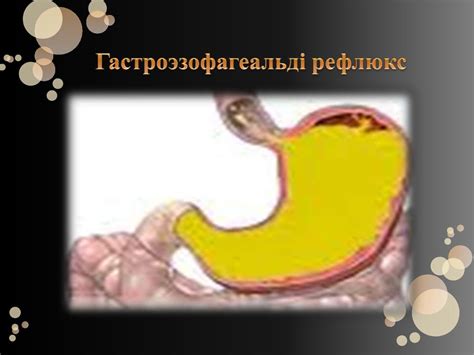Гастроэзофагеальді рефлюкстік ауру - презентация онлайн