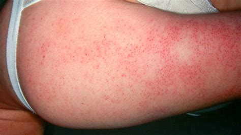 Understanding The Skin Condition Keratosis Pilaris