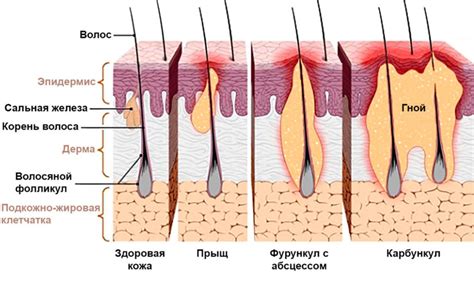 Гнойный гидраденит: что это такое, причины, симптомы, лечение, прогноз