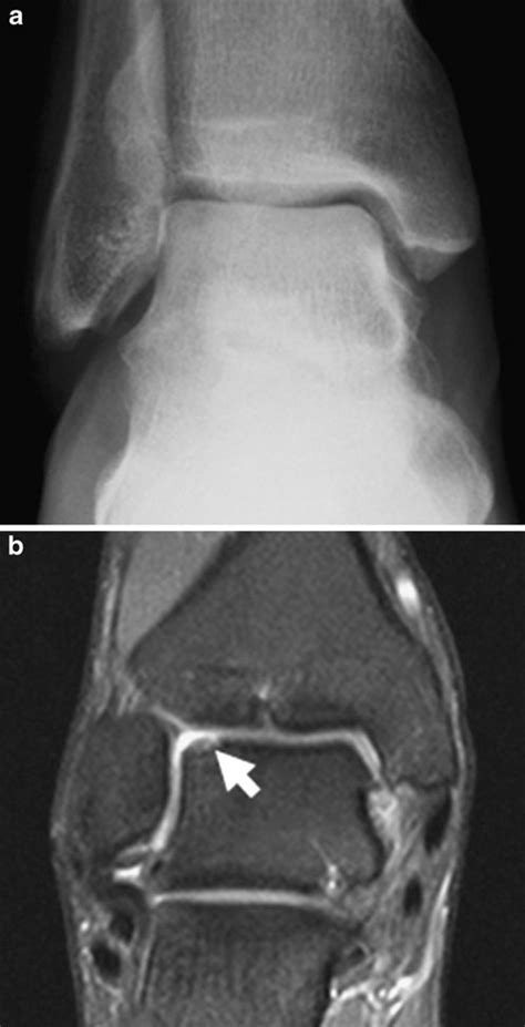 osteochondral lesion  ap radiograph   ankle reported  normal