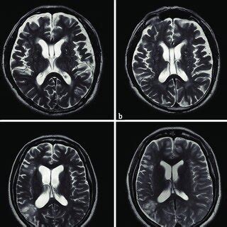 The brain magnetic resonance imaging before the shunt surgery revealed ...