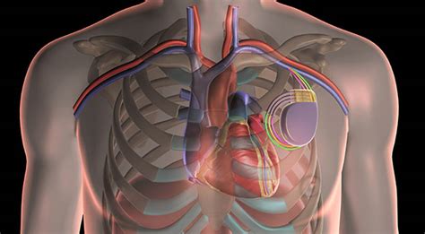 Cardiac Resynchronization Therapy Crt