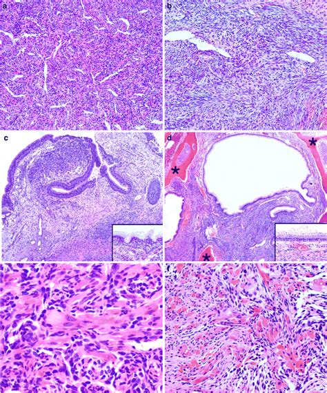 Histological Characteristic Of Biphenotypic Sinonasal Sarcoma A B