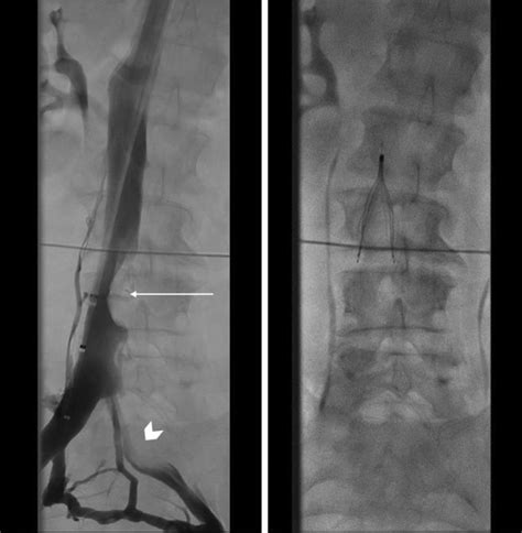 Cavogram Left Demonstrating Eccentric Filling Defect In The Low Ivc