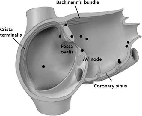 Clinical characteristics and rhythm outcome of catheter ablation of hemodynamically corrected ...