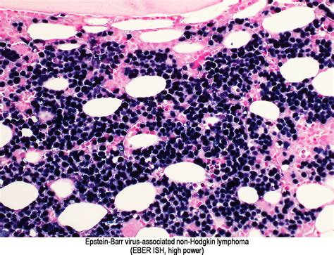 Pathology Outlines Epstein Barr Virus