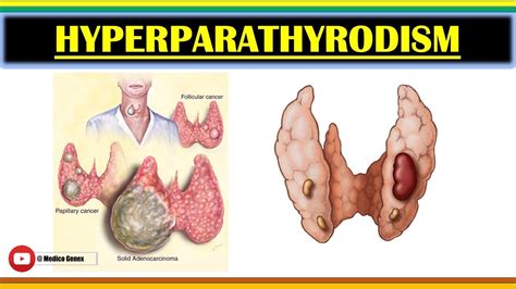 Hyperparathyroidism Sign And Symptoms Of Hyperparathyroidism Causes