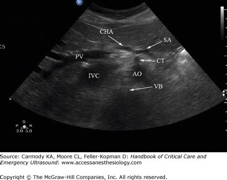 Ultrasound of the Aorta | Anesthesia Key