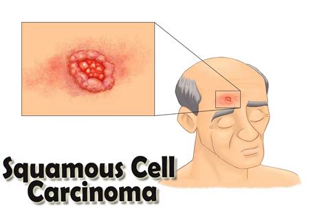 Patients With Head And Neck Squamous Cell Carcinoma At Significant Risk