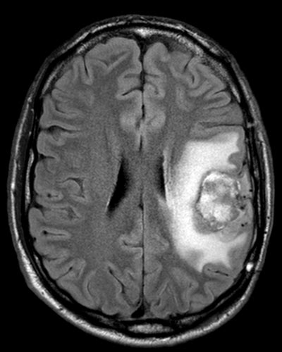 Glioblastoma Life Expectancy - What Can You Expect? - Survival With Kids