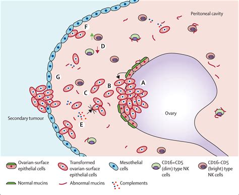 Clinical Potential Of Mucins In Diagnosis Prognosis And Therapy Of Ovarian Cancer The Lancet