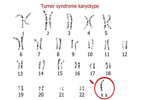 Turner's Mosaic Syndrome: Symptoms, Diagnosis & Treatment