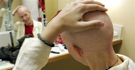 Cold Caps Tested To Prevent Hair Loss During Chemo Cbs Dfw