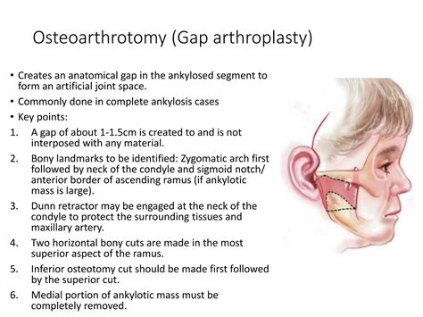 Temporomandibular Joint Ankylosis And Its Management Ppt