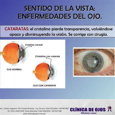 Cl Nica De Ojos Oftalmic L Ser Sentido De La Vista Enfermedades Del Ojo