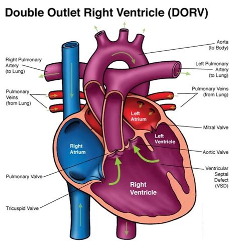 Double Outlet Right Ventricle - Repair, Surgery & Survival Rate