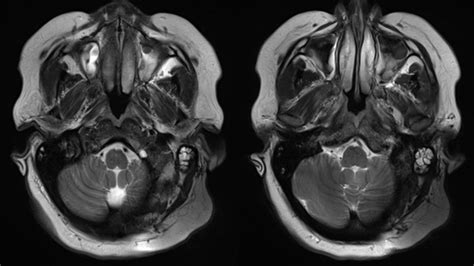 3.0 T MRI With SYNCHRONY Cochlear Implant: An MRI Technologist’s ...