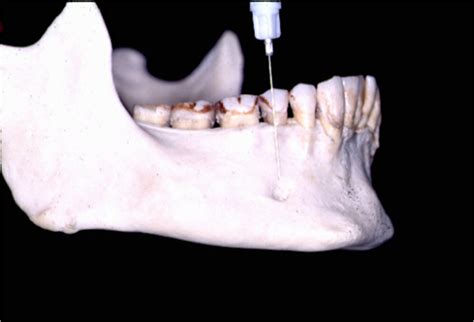 Techniques Of Mandibular Anesthesia Including Inferior Alveoar Nerve Block