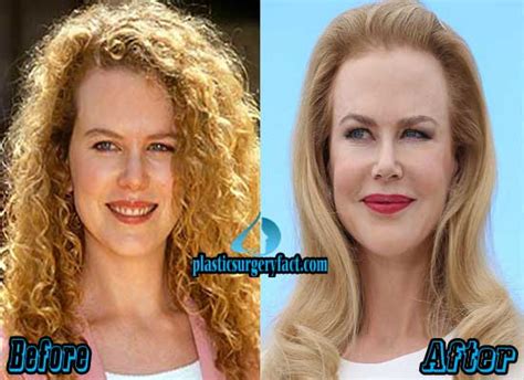 Nicole Kidman Plastic Surgery Before And After Pictures