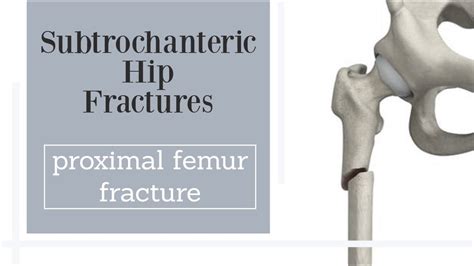 Subtrochanteric Hip Fractures Proximal Femur Fractures Youtube