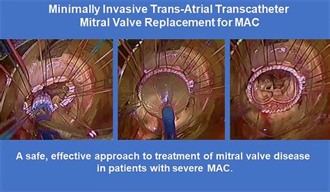 Minimally Invasive Treatment Of Mitral Valve Disease With Severe Mitral