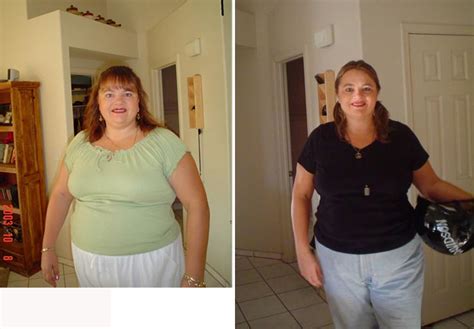 Before and After Lap Band Surgery - PICTURES ONLY - Weight Loss Surgery Success Stories ...