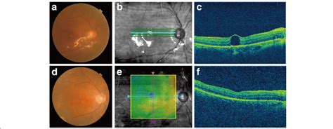 Multimodal Imaging Of The Affected Eye A Preoperative Fundus