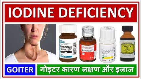 Iodine Deficiency Disease Goiter Causes Symptoms Diagnosis Treatment गोइटर कारण लक्षण और