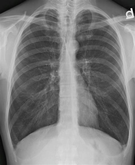 Emphysema Chest X Ray