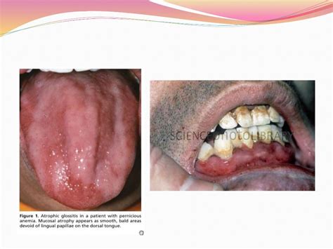 Oral Manifestations Of Systemic Diseases